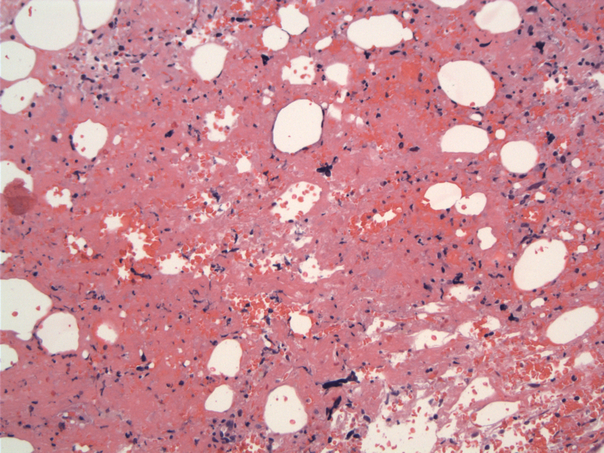 Stromal hemorrhage and fibrin and hyperchromatic megakaryocytes